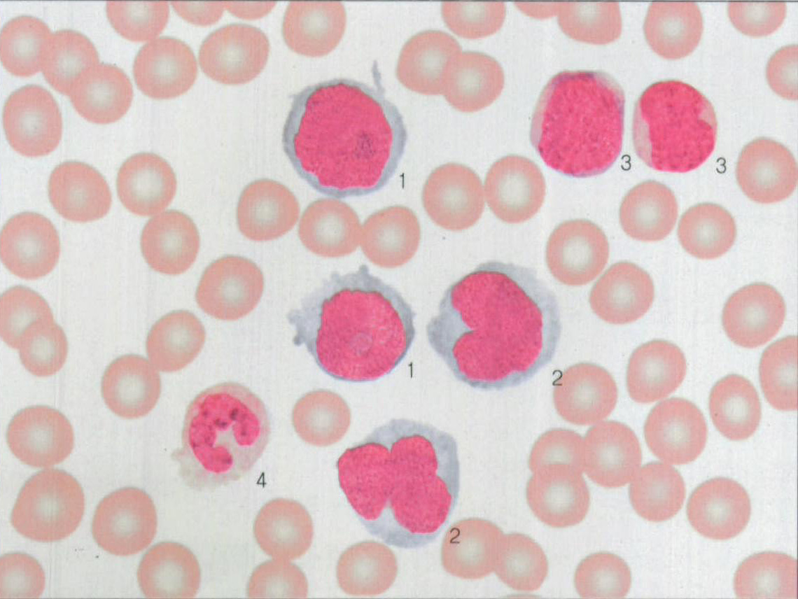 图203 慢性粒细胞白血病急性单核细胞白血病病变血象